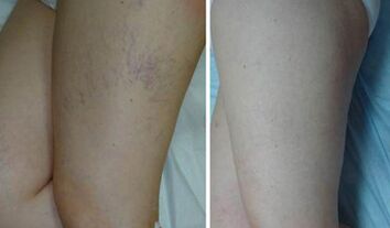 veins before and after applying the gel